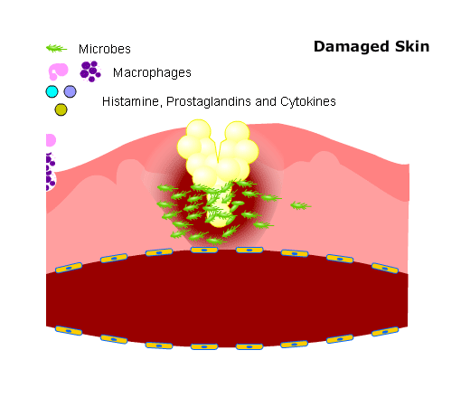 Damaged skin: animation showing inflammatory response with microbes, macrophages and histamine, prostaglandins and cytokines